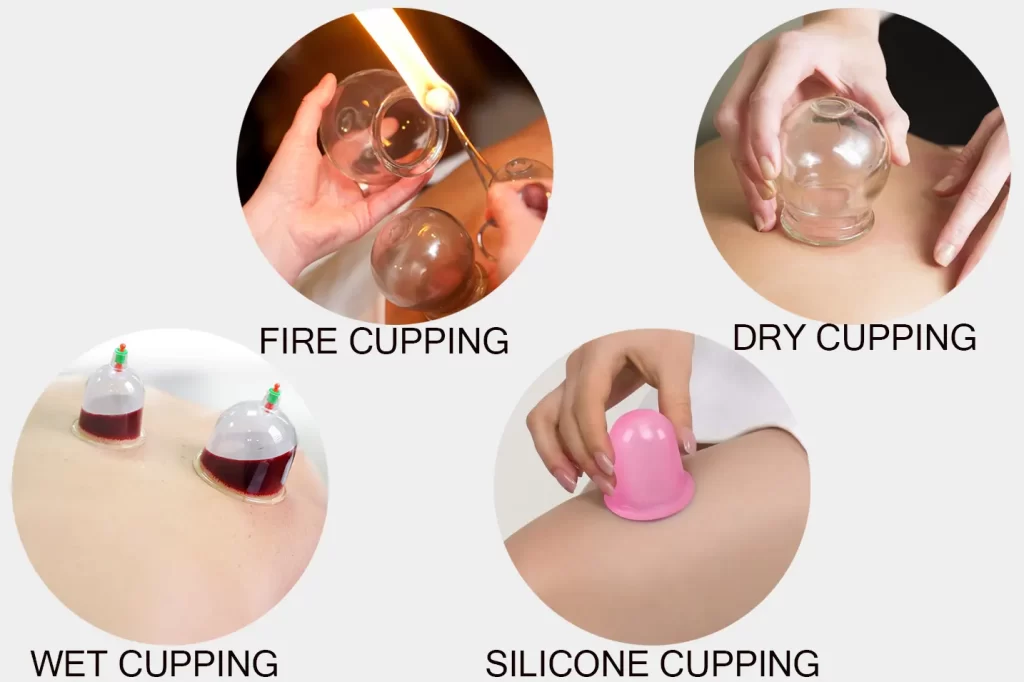 CUPPING TYPE1