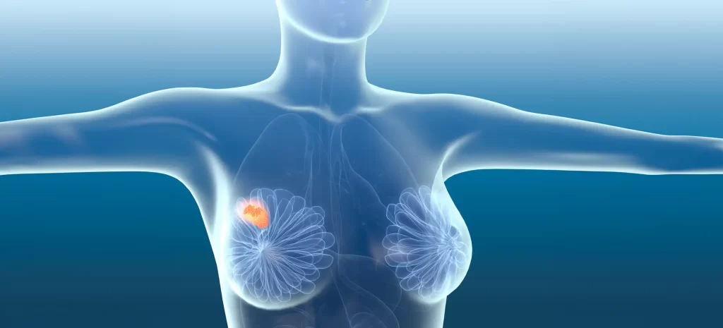 Breast cancer symptoms