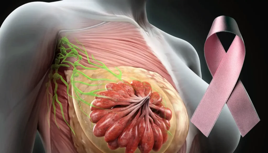 How I knew I had inflammatory breast cancer?