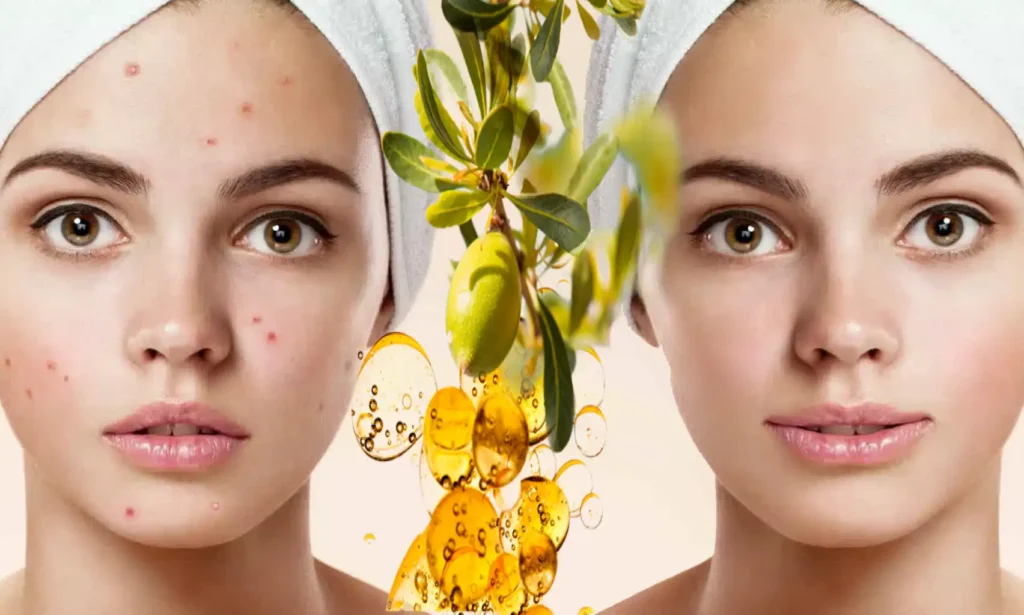 skin acne