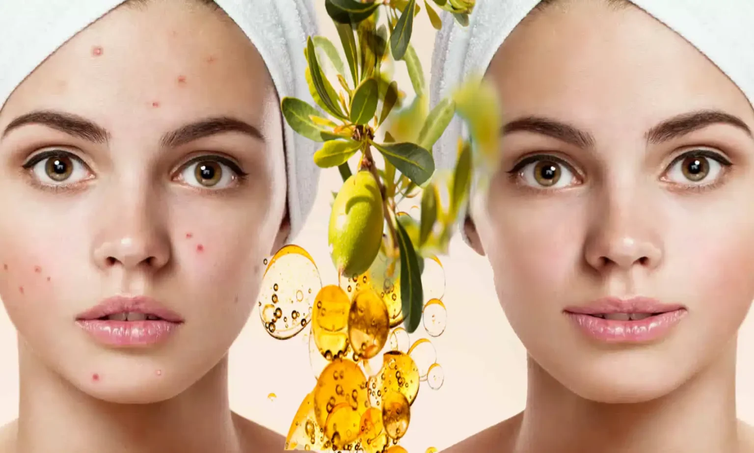 skin acne