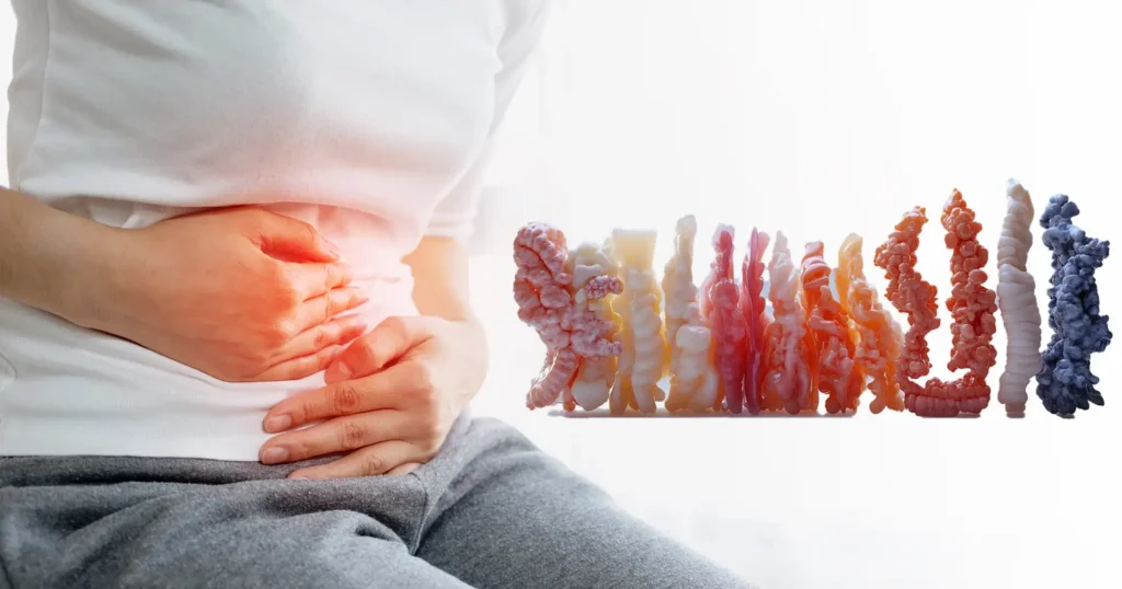 Colon Cancer Stages